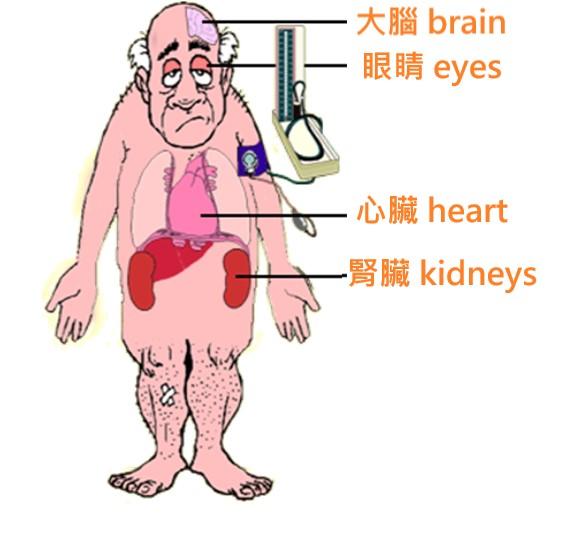 中風併發症 